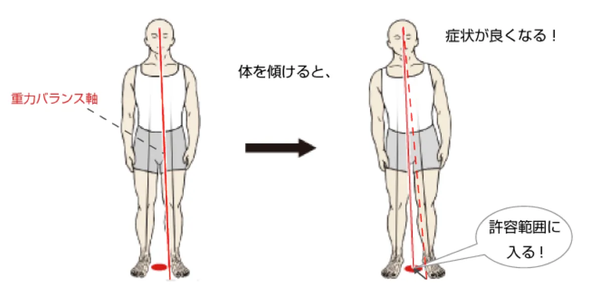重力バランス療法